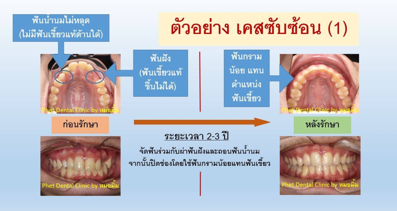 106668095_2832918506936473_3148076612893548603_n.jpg - รีวิวเคสจัดฟัน โดยหมอมิ้ม (ทญ.พนิตา สืบสุรีย์กุล) | https://phetdental.com