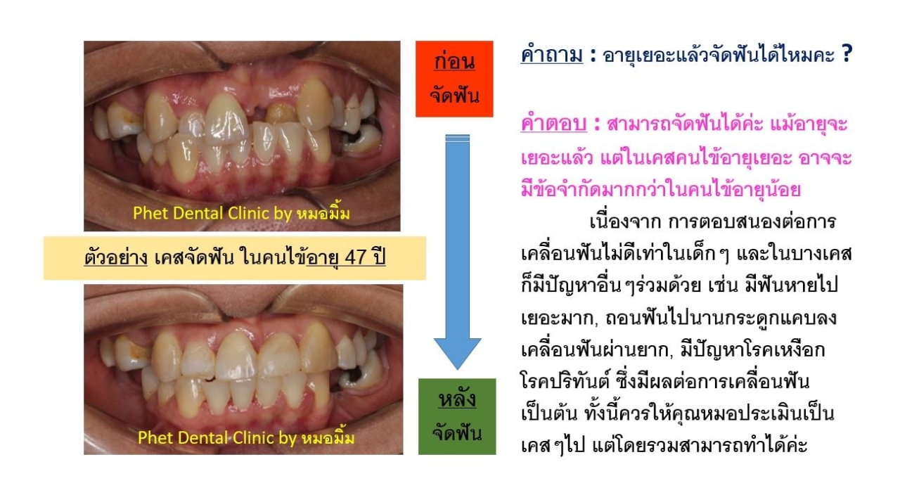 129861430_2976276055934050_3798566097998144479_n.jpg - รีวิวเคสจัดฟัน โดยหมอมิ้ม (ทญ.พนิตา สืบสุรีย์กุล) | https://phetdental.com