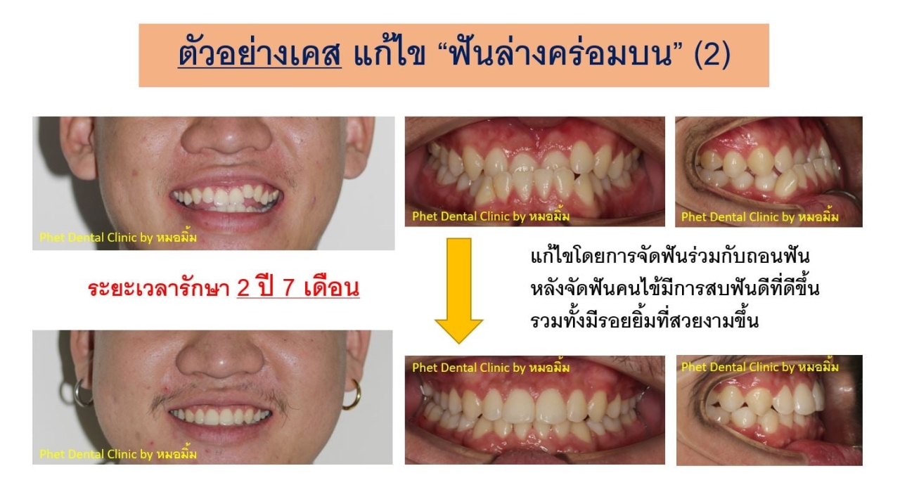 143146994_3016294808598841_6004426937526681585_n.jpg - รีวิวเคสจัดฟัน โดยหมอมิ้ม (ทญ.พนิตา สืบสุรีย์กุล) | https://phetdental.com