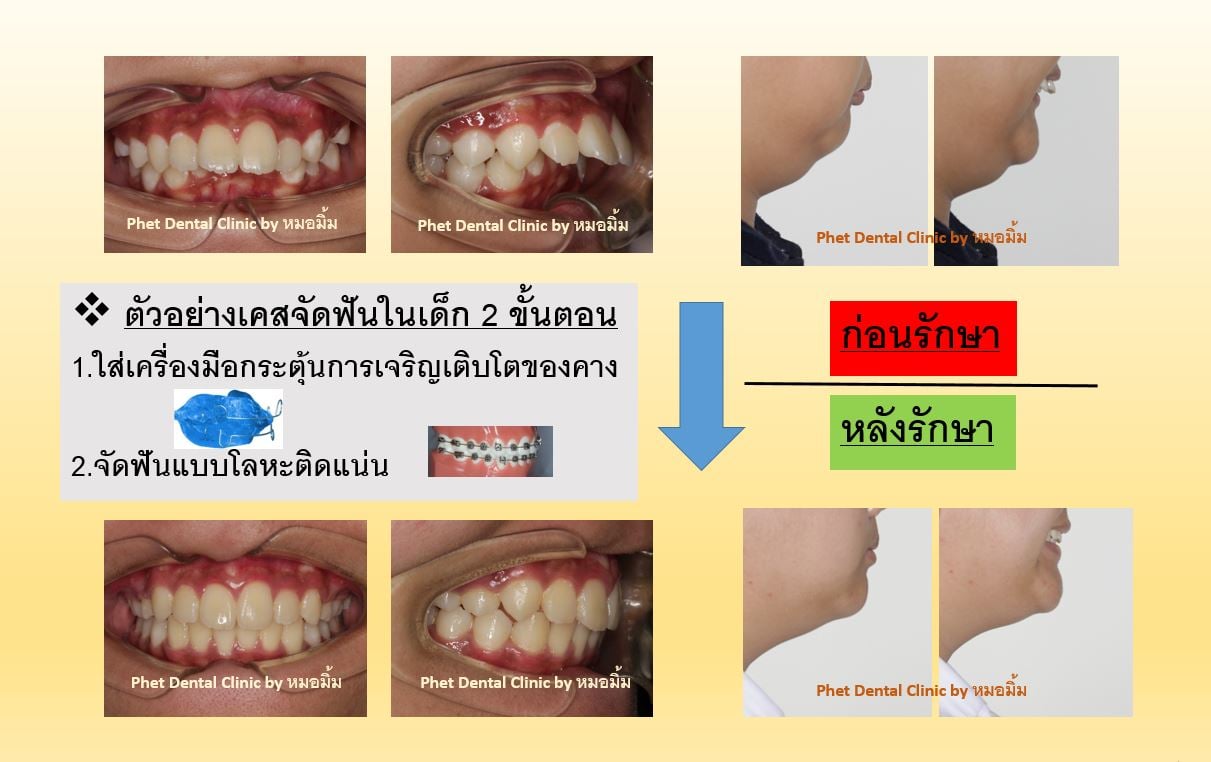 184387697_3090869117808076_3522046717340639762_n.jpg - รีวิวเคสจัดฟัน โดยหมอมิ้ม (ทญ.พนิตา สืบสุรีย์กุล) | https://phetdental.com