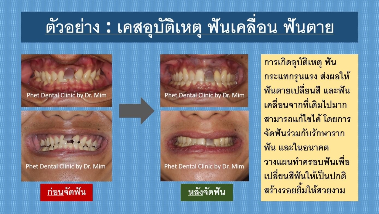 296996347_3435118080049843_198499036953656649_n.jpg - รีวิวเคสจัดฟัน โดยหมอมิ้ม (ทญ.พนิตา สืบสุรีย์กุล) | https://phetdental.com