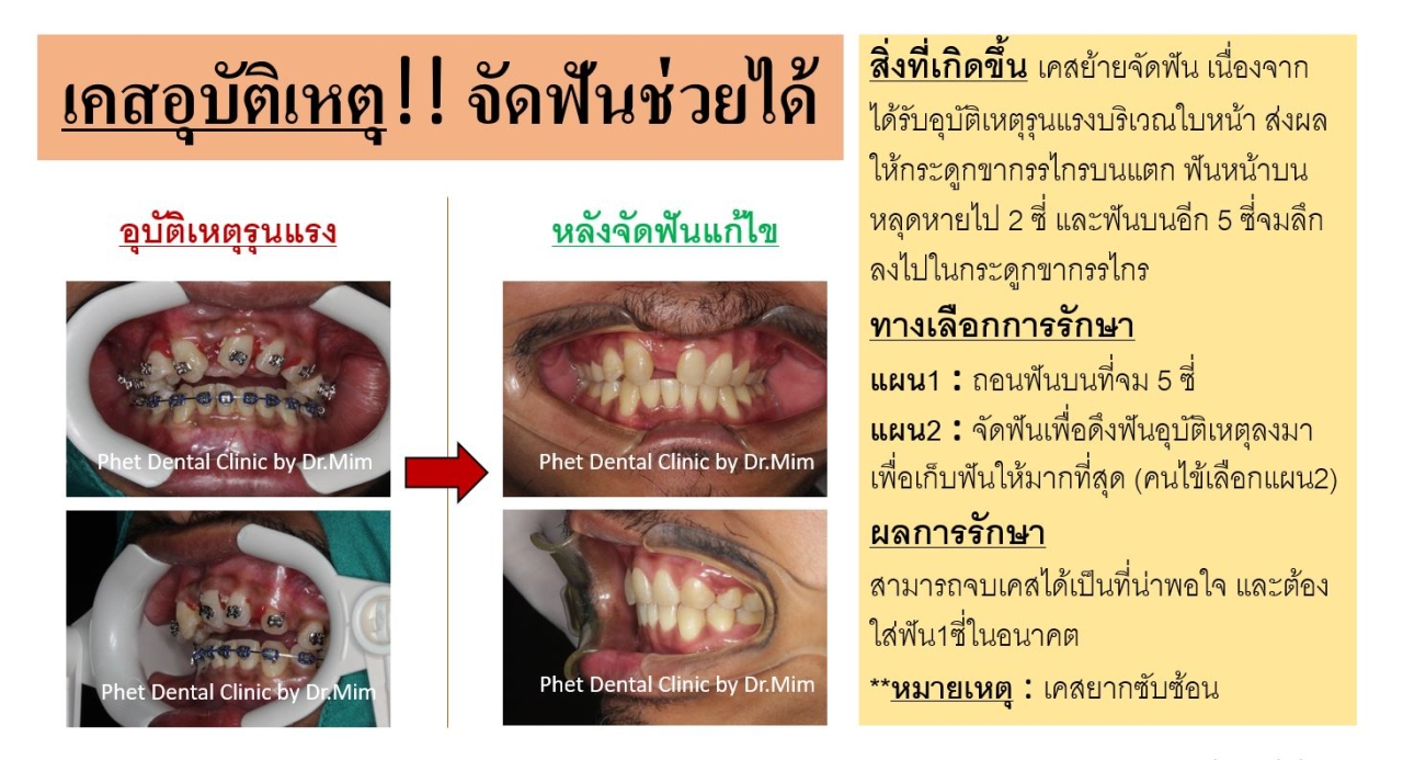 375217287_781808500621033_4826679337713545665_n.jpg - รีวิวเคสจัดฟัน โดยหมอมิ้ม (ทญ.พนิตา สืบสุรีย์กุล) | https://phetdental.com