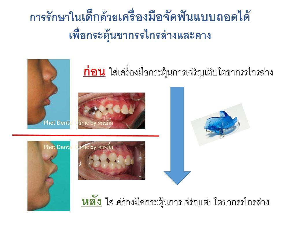 41681734_2305968916298104_6065838498902966272_n.jpg - รีวิวเคสจัดฟัน โดยหมอมิ้ม (ทญ.พนิตา สืบสุรีย์กุล) | https://phetdental.com