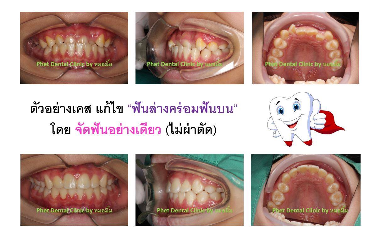 44515333_2328350120726650_2105558818661335040_n.jpg - รีวิวเคสจัดฟัน โดยหมอมิ้ม (ทญ.พนิตา สืบสุรีย์กุล) | https://phetdental.com