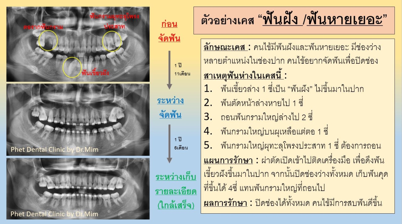 453754331_1024922932976254_426207388197197758_n.jpg - รีวิวเคสจัดฟัน โดยหมอมิ้ม (ทญ.พนิตา สืบสุรีย์กุล) | https://phetdental.com