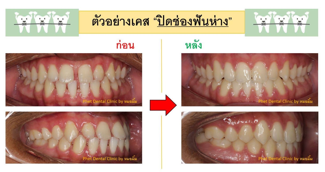 46342202_2344062322488763_3875523169284521984_n.jpg - รีวิวเคสจัดฟัน โดยหมอมิ้ม (ทญ.พนิตา สืบสุรีย์กุล) | https://phetdental.com