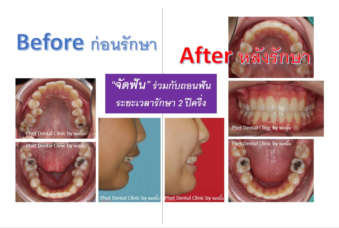 463444417_4057469404481371_701703299942924686_n.jpg - รีวิวเคสจัดฟัน โดยหมอมิ้ม (ทญ.พนิตา สืบสุรีย์กุล) | https://phetdental.com