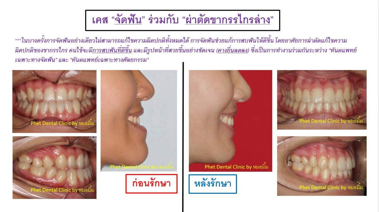 463733140_4057469391148039_5808590930634284303_n.jpg - รีวิวเคสจัดฟัน โดยหมอมิ้ม (ทญ.พนิตา สืบสุรีย์กุล) | https://phetdental.com