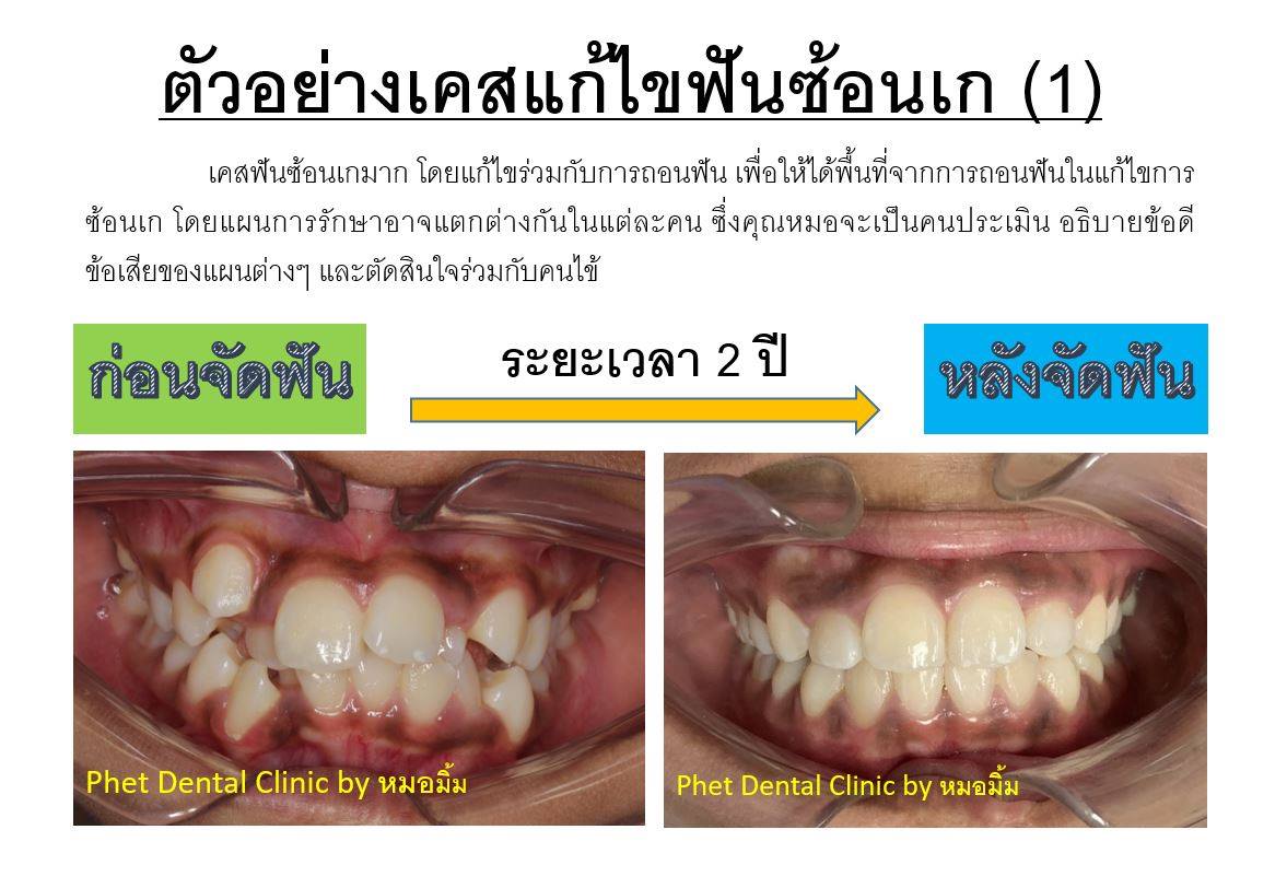 69945755_2559884397573220_7698864440132763648_n.jpg - รีวิวเคสจัดฟัน โดยหมอมิ้ม (ทญ.พนิตา สืบสุรีย์กุล) | https://phetdental.com