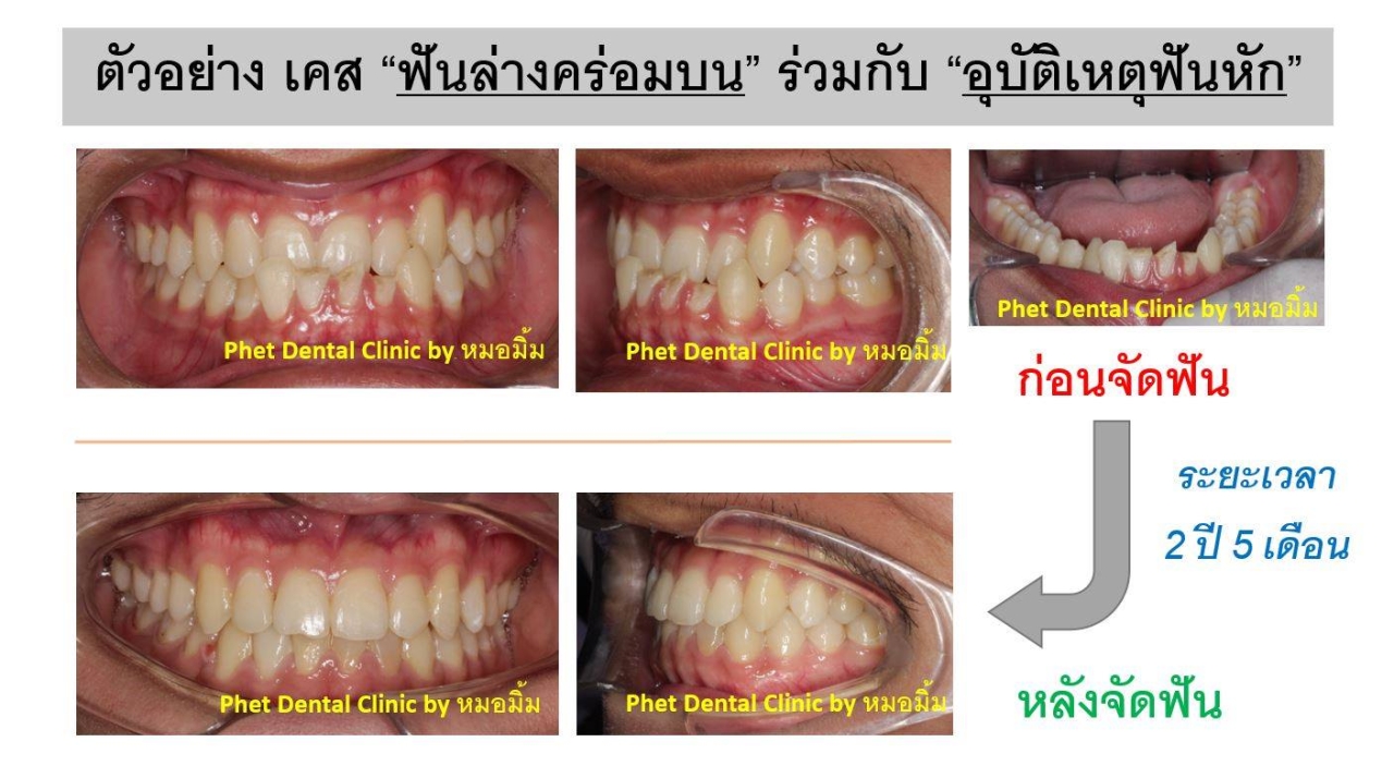 78957015_2646608135567512_7381284069956386816_n.jpg - รีวิวเคสจัดฟัน โดยหมอมิ้ม (ทญ.พนิตา สืบสุรีย์กุล) | https://phetdental.com